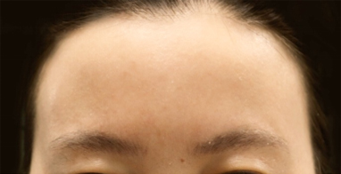 眉间纹患者招募